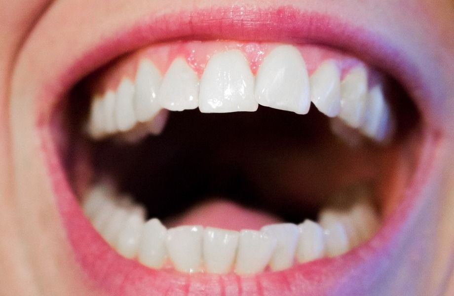 Фото 4 Студия косметического отбеливания зубов по уникальной методике